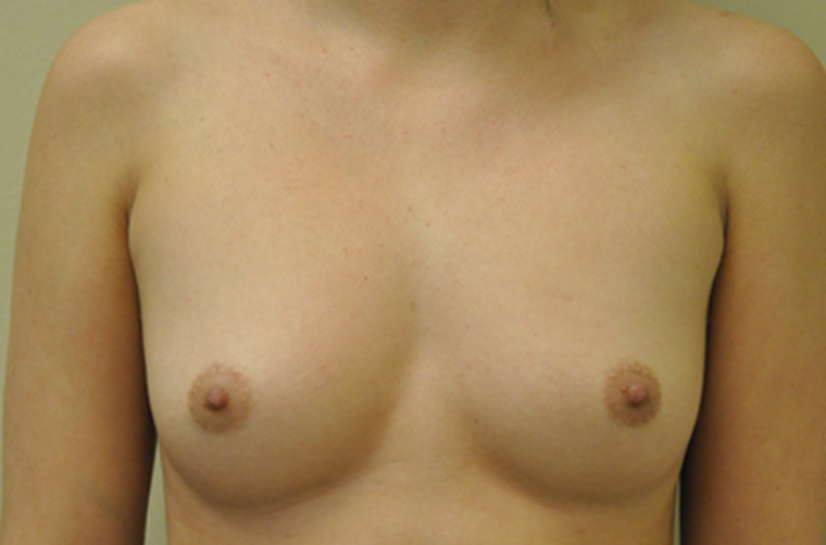 Breasts before breast augmentation, front view — Dr. Rudderman, Atlanta.