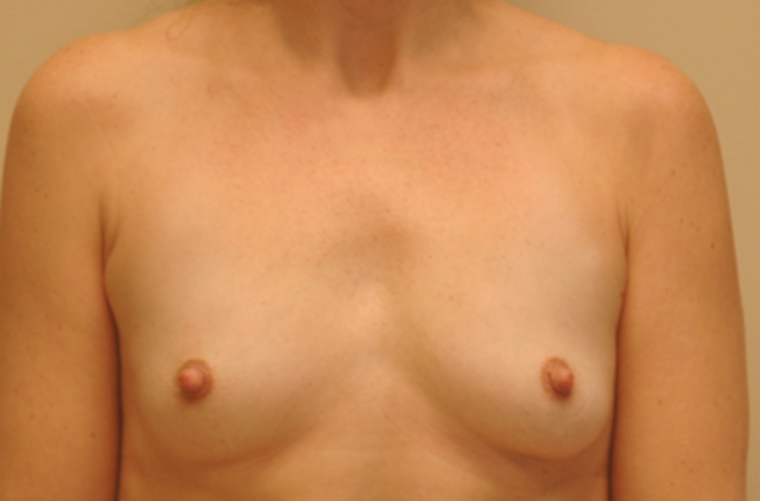 Breasts before breast augmentation, front view — Dr. Rudderman, Atlanta.
