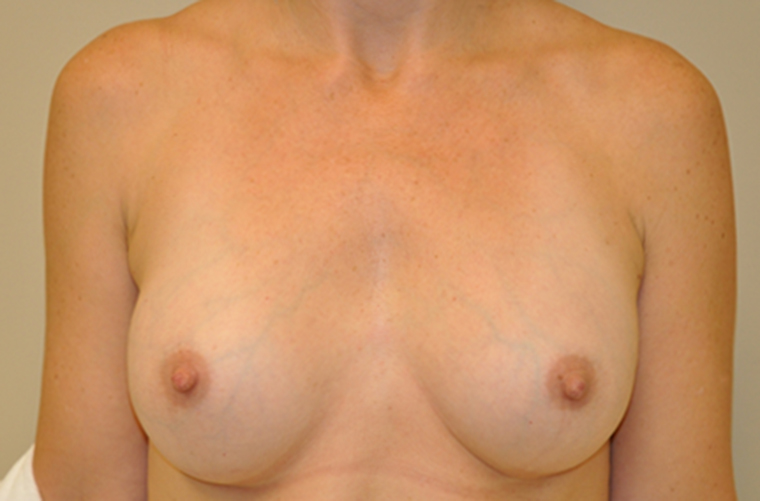 Breasts after breast augmentation, front view — Dr. Rudderman, Atlanta.