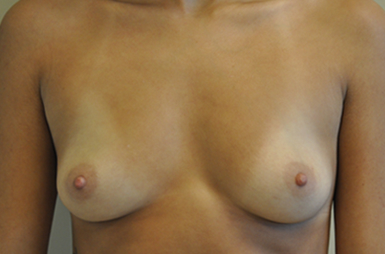 Breasts before breast augmentation, front view — Dr. Rudderman, Atlanta.