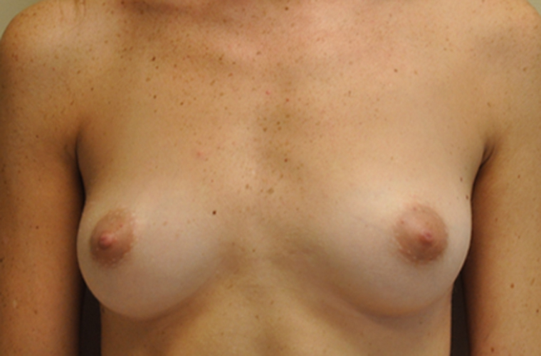 Breasts before breast augmentation, front view — Dr. Rudderman, Atlanta.