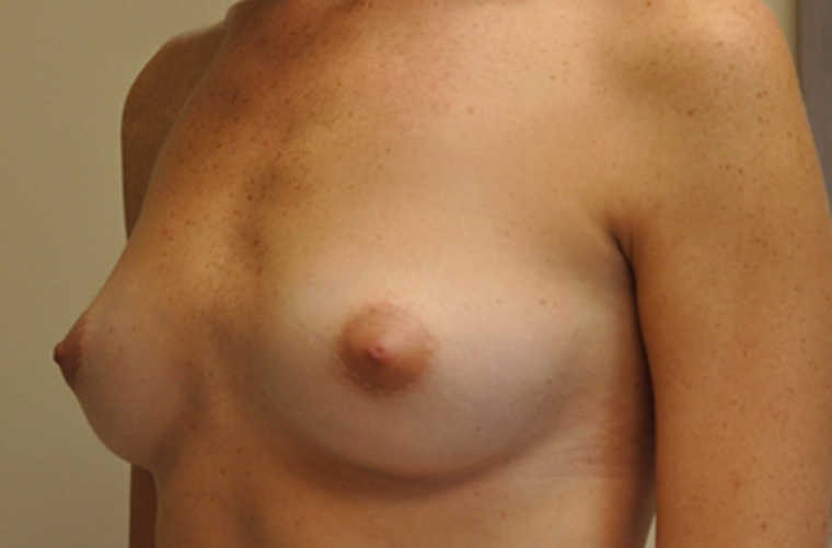 Breasts before breast augmentation, three-quarter view — Dr. Rudderman, Atlanta.