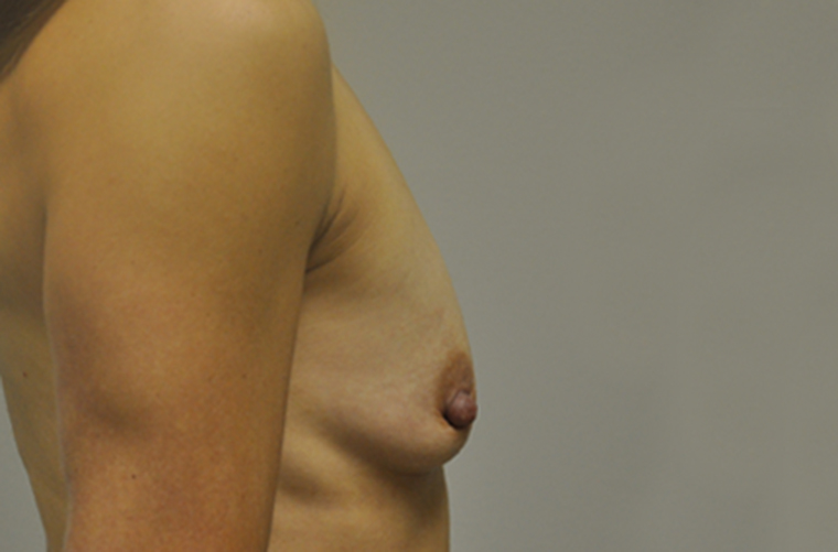 Breasts before breast augmentation, side profile view — Dr. Rudderman, Atlanta.