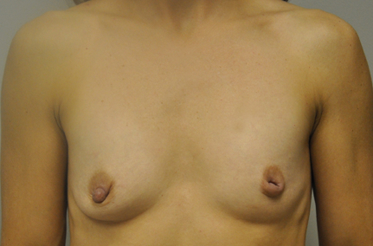 Breasts before breast augmentation, front view — Dr. Rudderman, Atlanta.