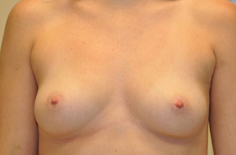 Breasts before breast augmentation, front view — Dr. Rudderman, Atlanta.