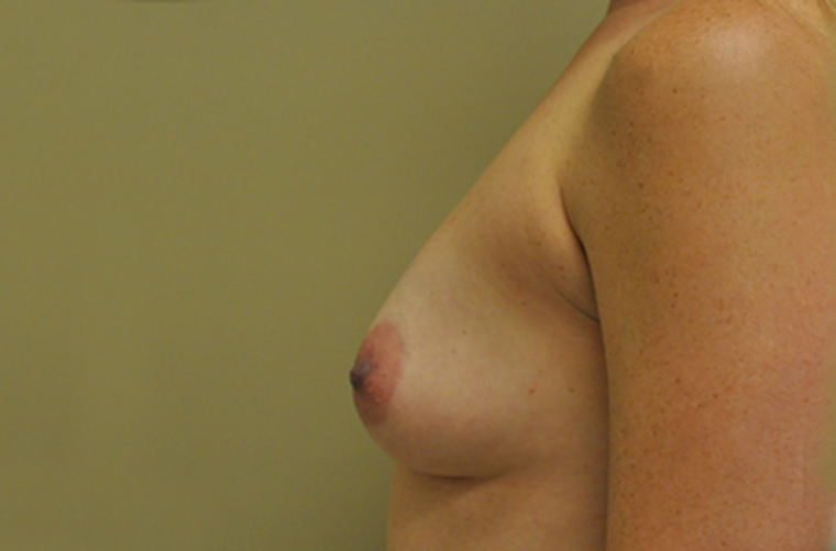 Breasts before breast augmentation, side profile view — Dr. Rudderman, Atlanta.