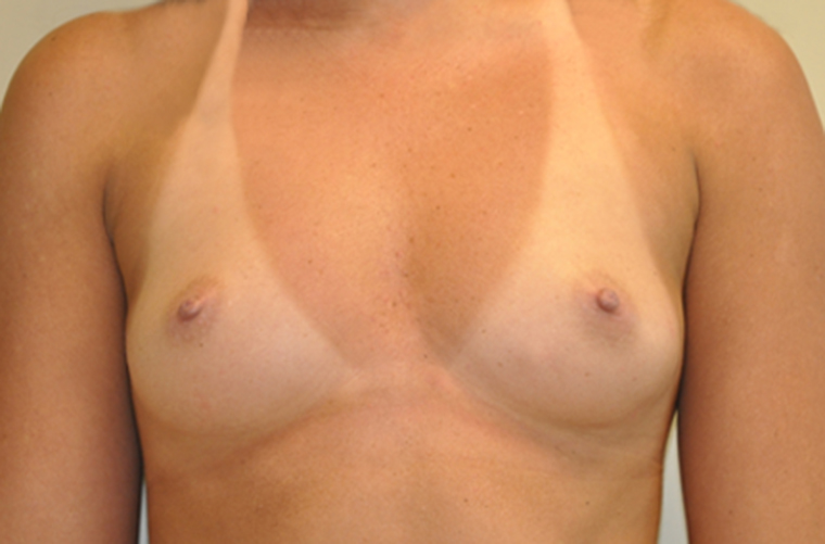 Breasts before breast augmentation, front view — Dr. Rudderman, Atlanta.