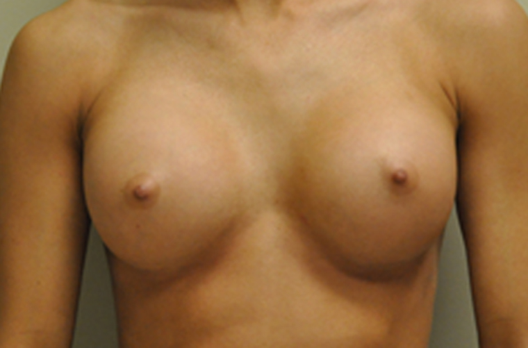 Breasts after breast augmentation, front view — Dr. Rudderman, Atlanta.
