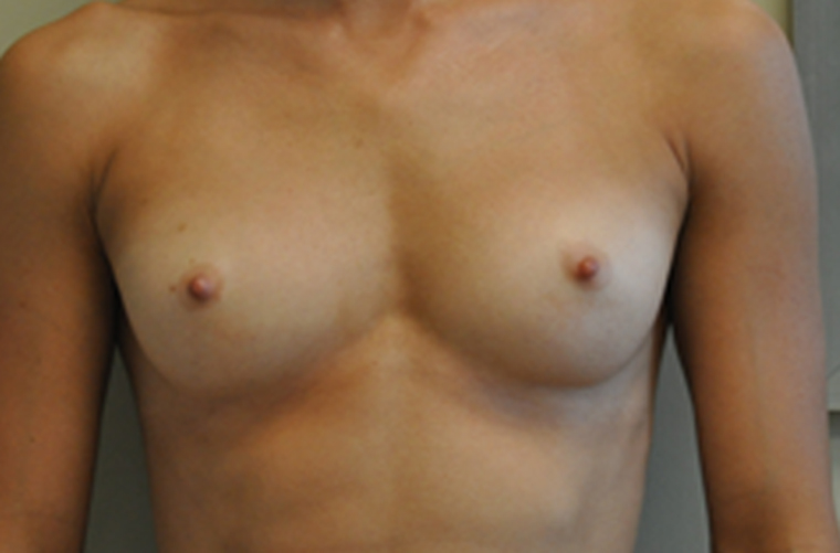 Breasts before breast augmentation, front view — Dr. Rudderman, Atlanta.