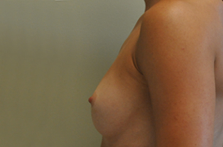 Breasts before breast augmentation, side profile view — Dr. Rudderman, Atlanta.
