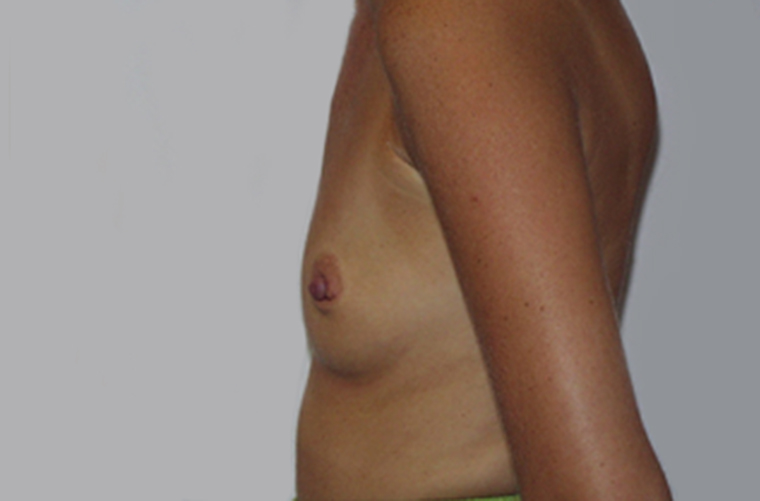 Breasts before breast augmentation, side profile view — Dr. Rudderman, Atlanta.