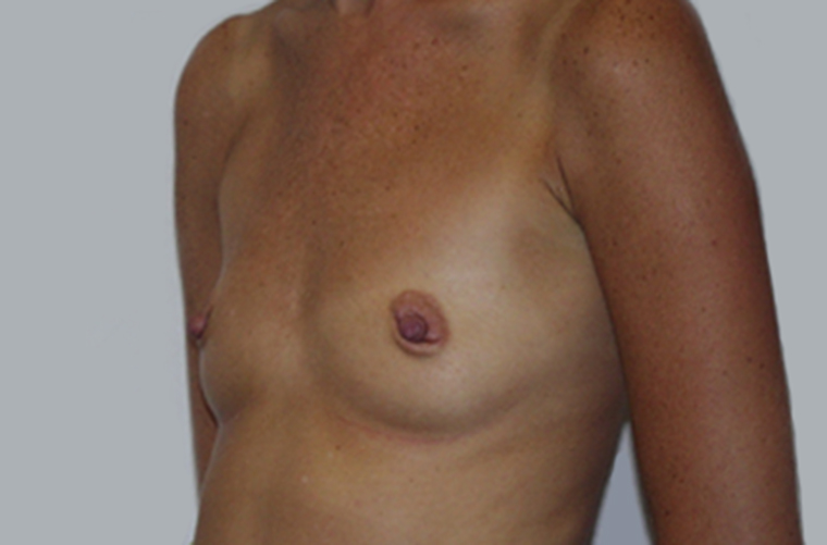 Breasts before breast augmentation, three-quarter view — Dr. Rudderman, Atlanta.
