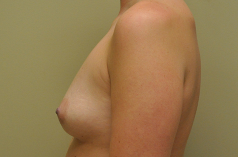 Breasts before breast augmentation, side profile view — Dr. Rudderman, Atlanta.