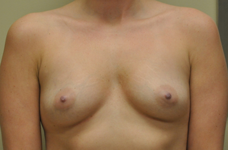 Breasts before breast augmentation, front view — Dr. Rudderman, Atlanta.