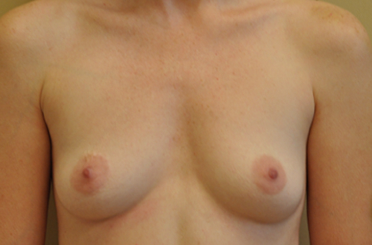 Breasts before breast augmentation, front view — Dr. Rudderman, Atlanta.