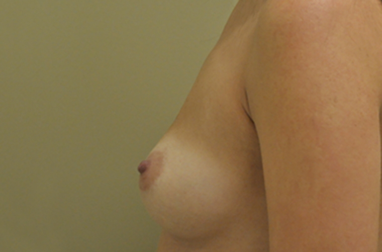 Breasts before breast augmentation, side profile view — Dr. Rudderman, Atlanta.