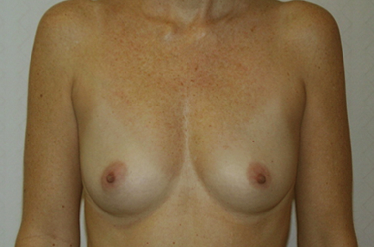 Breasts before breast augmentation, front view — Dr. Rudderman, Atlanta.