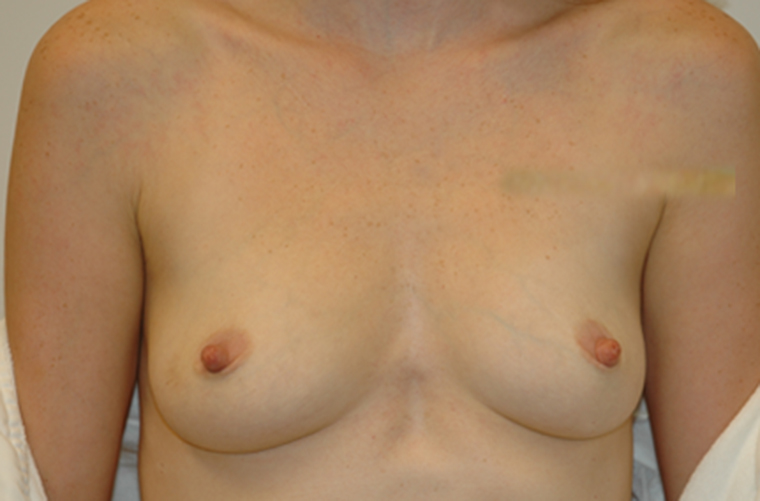 Breasts before breast augmentation, front view — Dr. Rudderman, Atlanta.