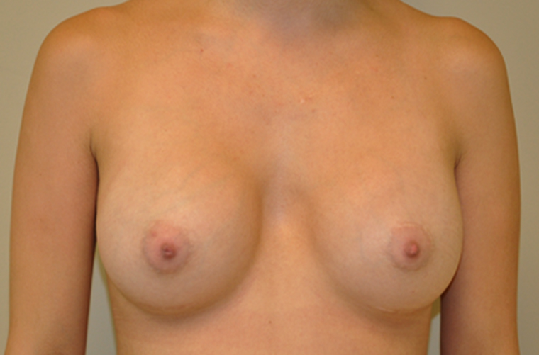 Breasts after breast augmentation, front view — Dr. Rudderman, Atlanta.