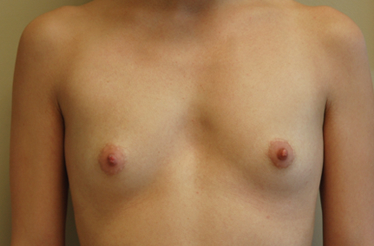 Breasts before breast augmentation, front view — Dr. Rudderman, Atlanta.