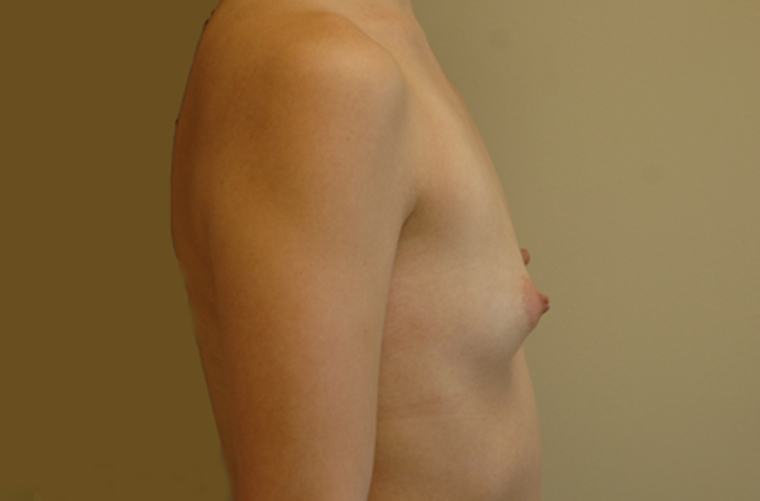 Breasts before breast augmentation, side profile view — Dr. Rudderman, Atlanta.