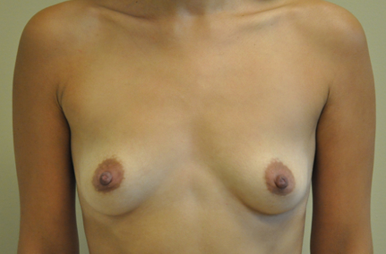 Breasts before breast augmentation, front view — Dr. Rudderman, Atlanta.