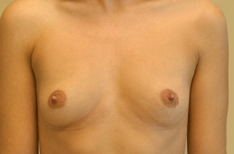 Breasts before breast augmentation, front view — Dr. Rudderman, Atlanta.
