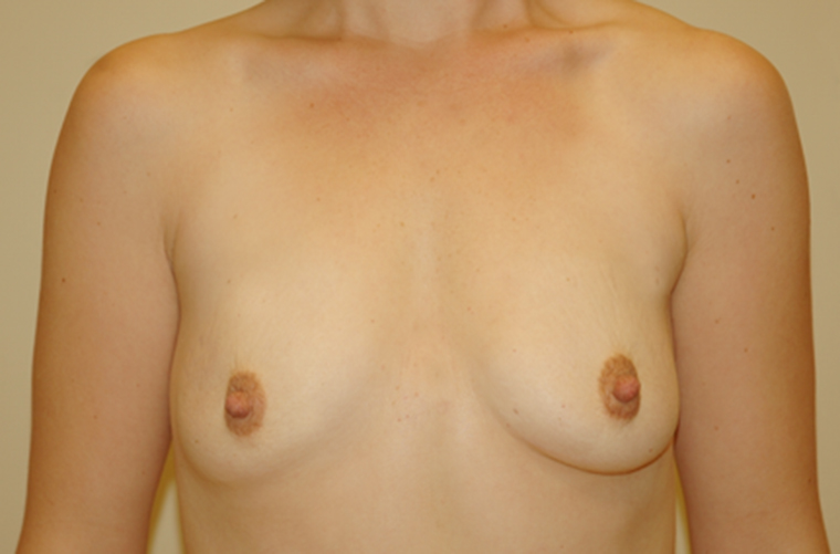 Breasts before breast augmentation, front view — Dr. Rudderman, Atlanta.