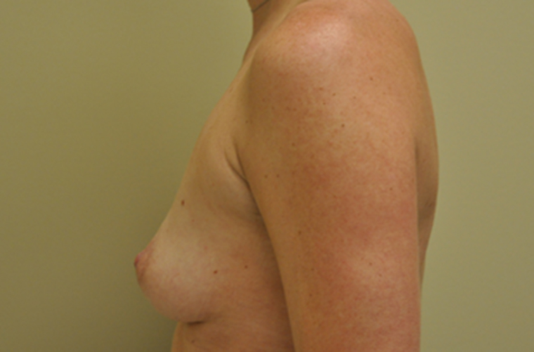 Breasts before breast augmentation, side profile view — Dr. Rudderman, Atlanta.
