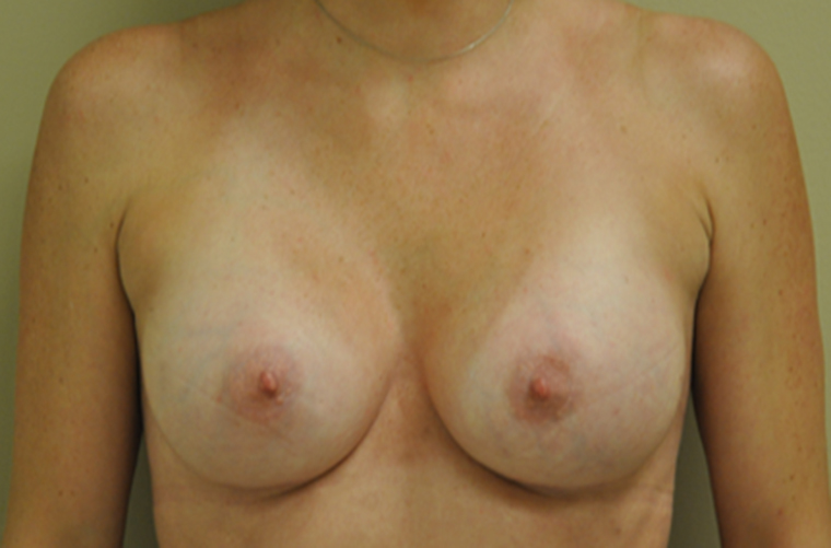 Breasts after breast augmentation, front view — Dr. Rudderman, Atlanta.