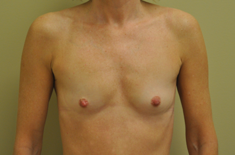Breasts before breast augmentation, front view — Dr. Rudderman, Atlanta.