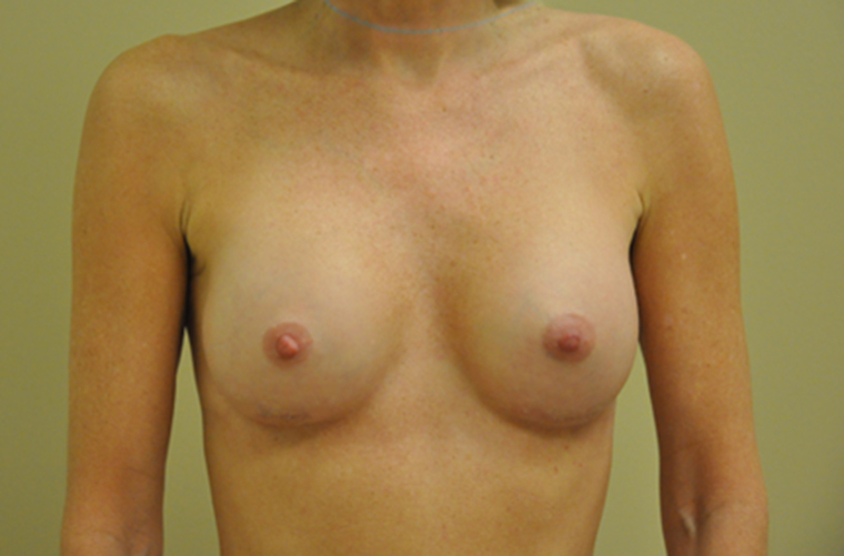 Breasts after breast augmentation, front view — Dr. Rudderman, Atlanta.