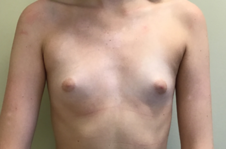 Breasts before breast augmentation, front view — Dr. Rudderman, Atlanta.