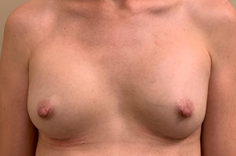 Breasts before breast augmentation, front view — Dr. Rudderman, Atlanta.