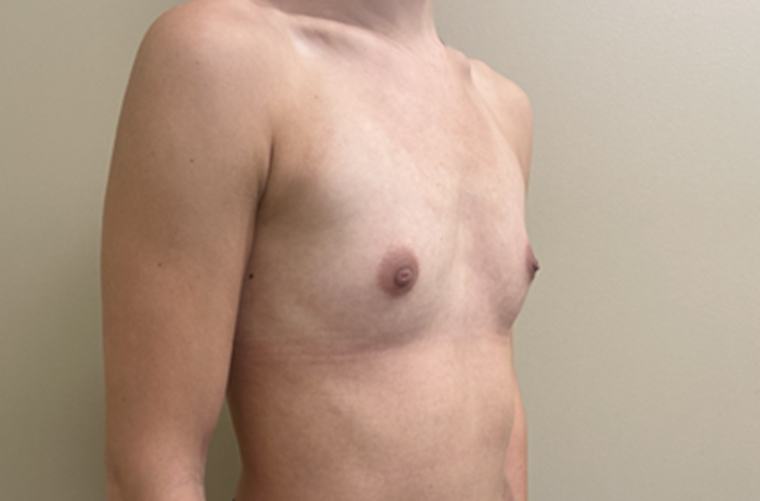Breasts before breast augmentation, three-quarter view — Dr. Rudderman, Atlanta.