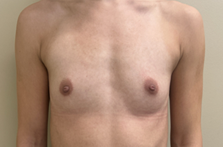 Breasts before breast augmentation, front view — Dr. Rudderman, Atlanta.