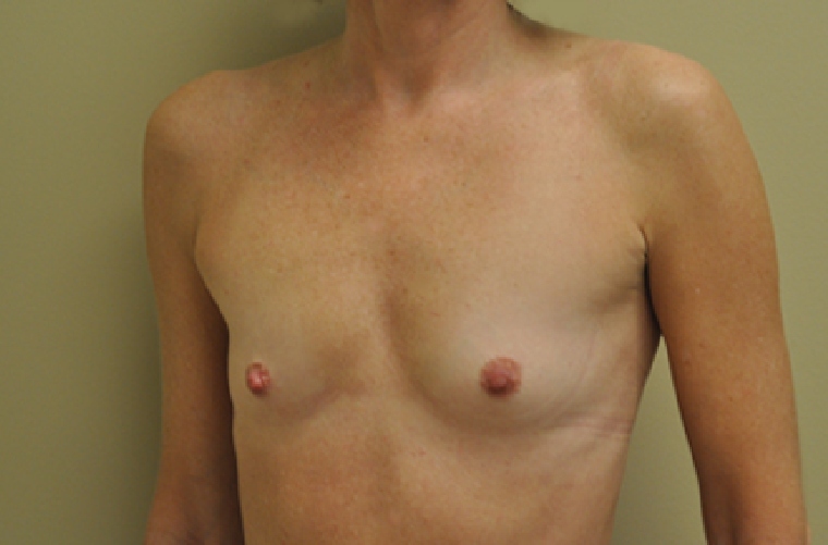 Breasts before breast augmentation, front view — Dr. Rudderman, Atlanta.