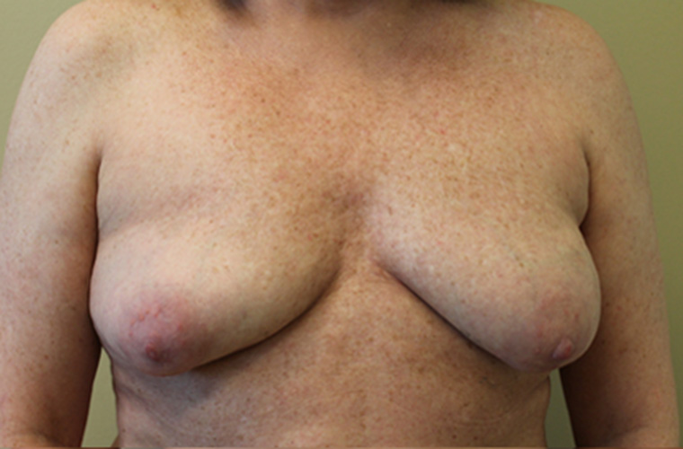 Breasts before breast implant removal, front view — Dr. Rudderman, Atlanta.