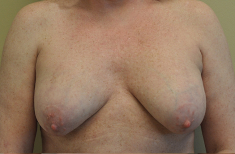 Breasts after breast implant removal, front view — Dr. Rudderman, Atlanta.