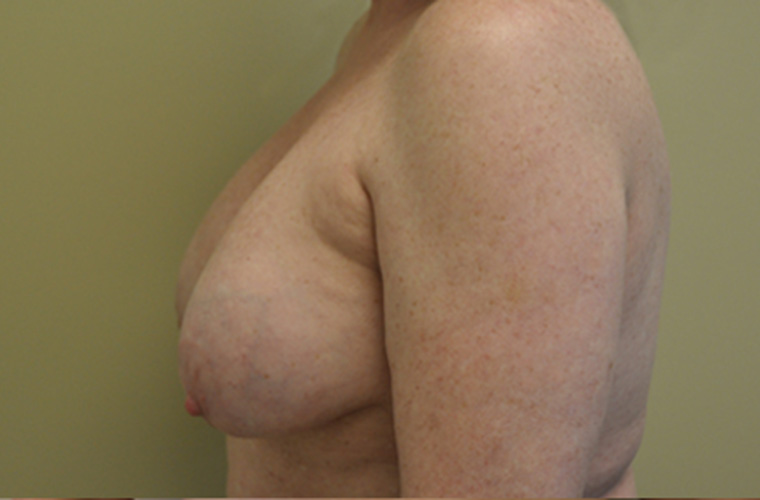 Breasts before breast implant removal, side profile view — Dr. Rudderman, Atlanta.