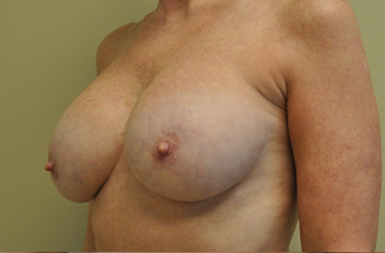 Breasts before breast implant removal, three-quarter view — Dr. Rudderman, Atlanta.