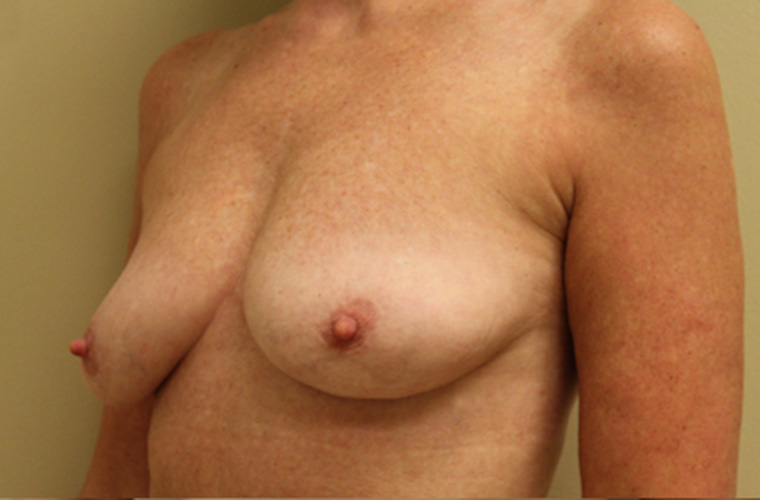 Breasts after breast implant removal, three-quarter view — Dr. Rudderman, Atlanta.