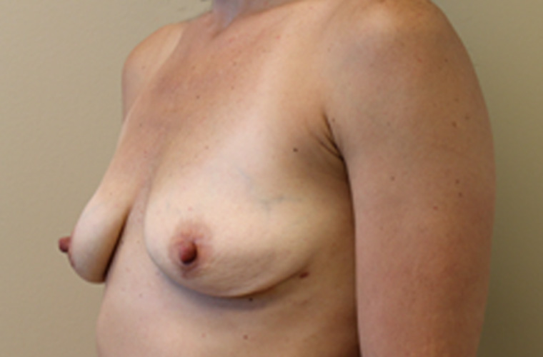Breasts after breast implant removal, three-quarter view — Dr. Rudderman, Atlanta.