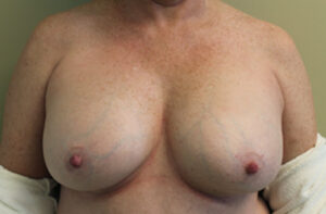 Breasts before breast implant removal, front view — Dr. Rudderman, Atlanta.