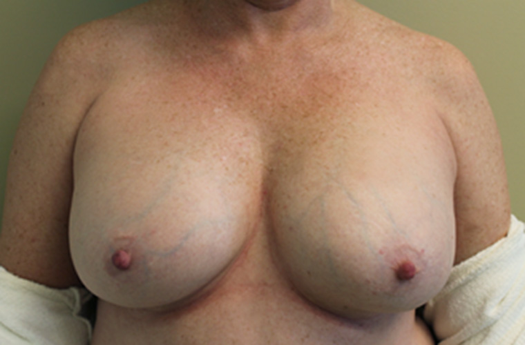 Breasts before breast implant removal, front view — Dr. Rudderman, Atlanta.