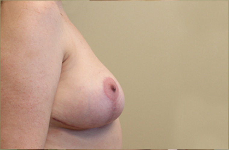 Breasts after breast implant removal, side profile view — Dr. Rudderman, Atlanta.