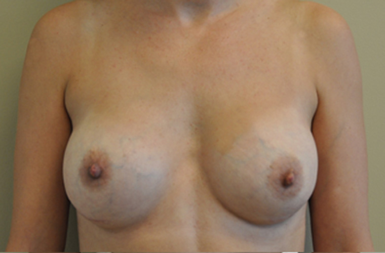 Breasts before breast implant removal, front view — Dr. Rudderman, Atlanta.