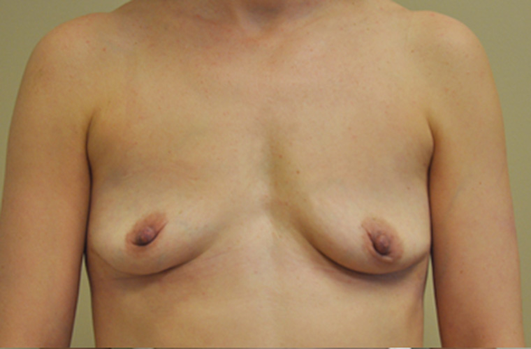 Breasts after breast implant removal, front view — Dr. Rudderman, Atlanta.