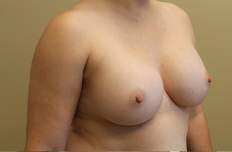 Breasts before breast implant removal, three-quarter view — Dr. Rudderman, Atlanta.