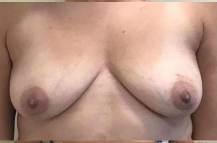 Breasts before breast implant removal, front view — Dr. Rudderman, Atlanta.